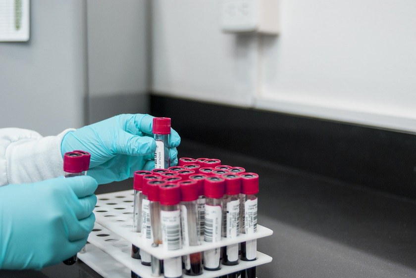 MEDIZIN: Neue Versuchsreihe für mögliche Heilung von HIV startet