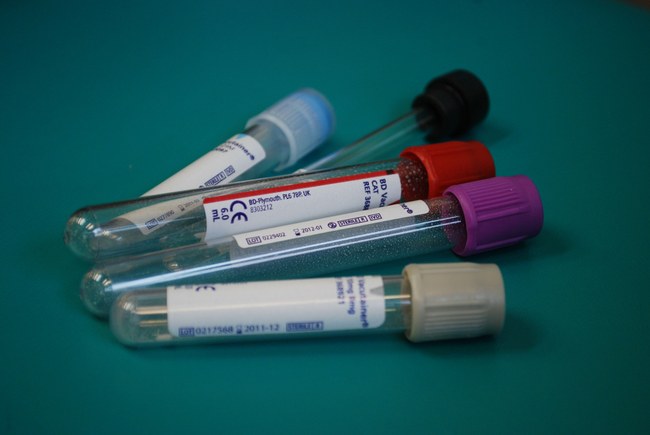 MEDIZIN: Wurde der bereits zehnte Mensch von HIV geheilt?